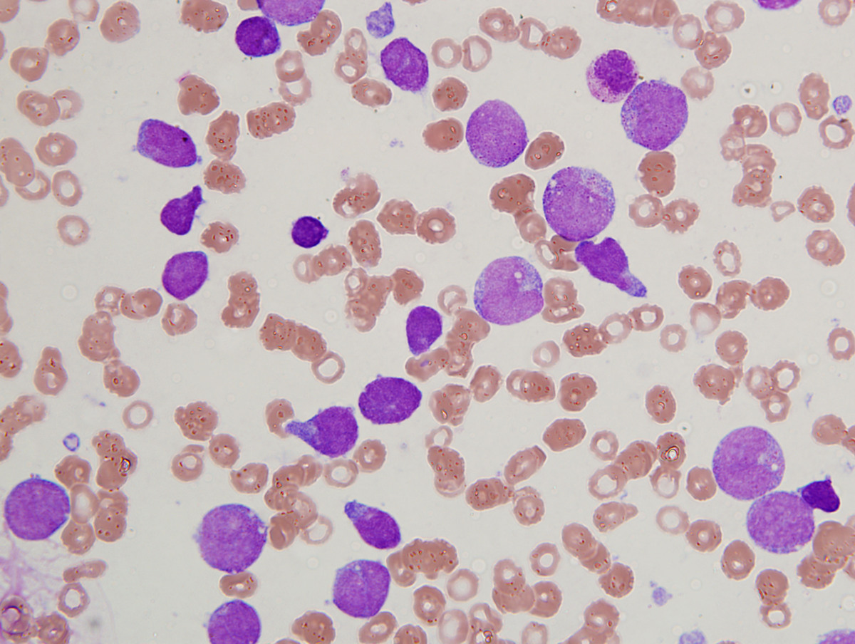 Figure 1 Aspirate Smear Intermediate power